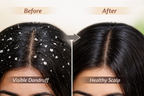 SCALPURE Neem + Tea Tree Anti-Dandruff Shampoo